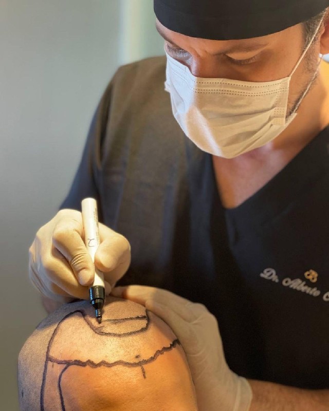Clinica de implante capilar
