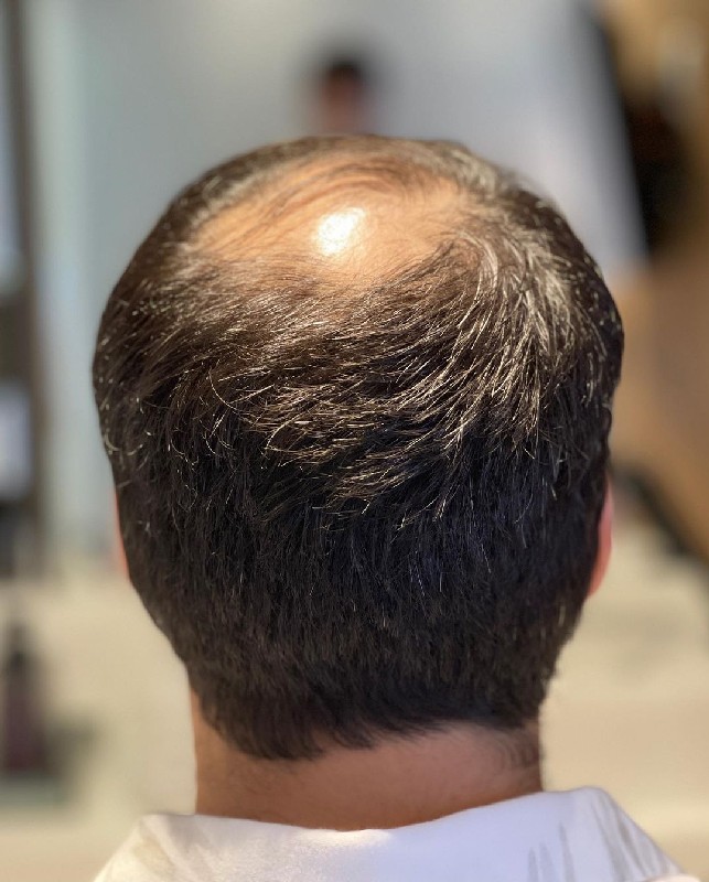 Fue transplante capilar