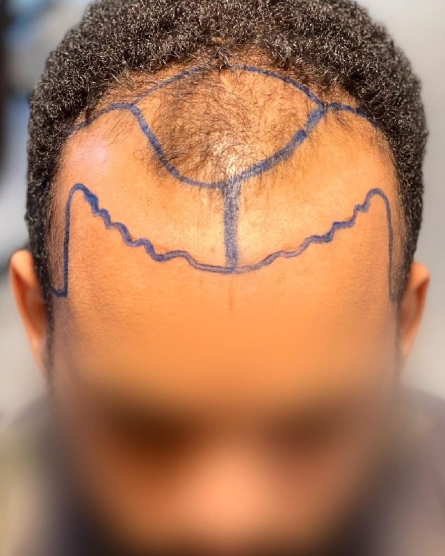 Fue transplante capilar preço