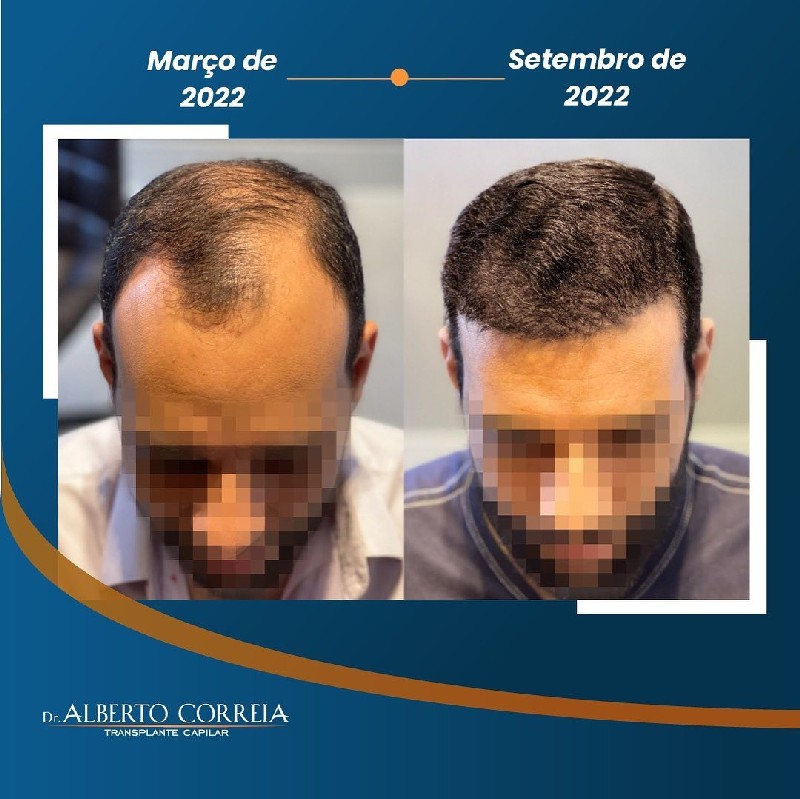Fue tratamento capilar preço