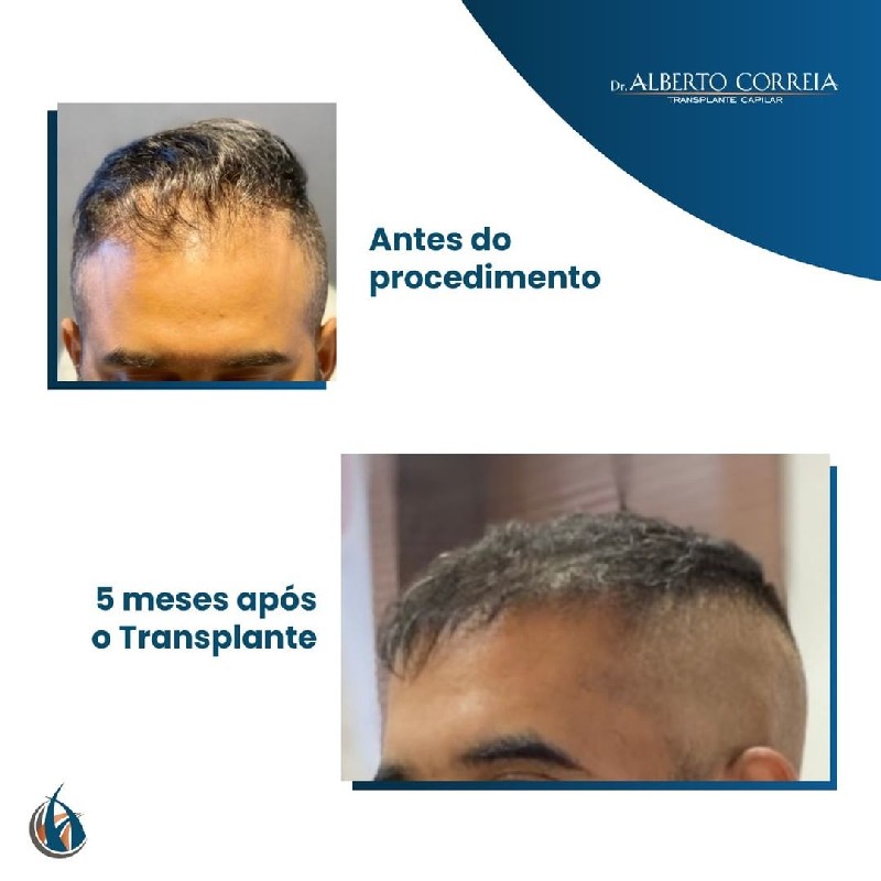 Implante de cabelo para diminuir a testa