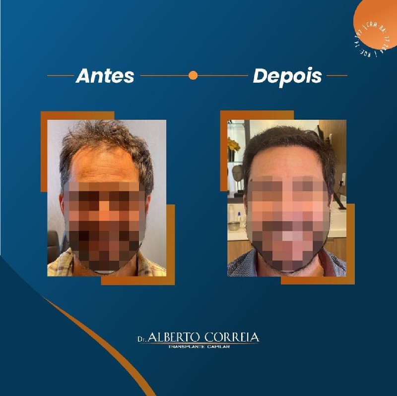 Implante de cabelo masculino preço