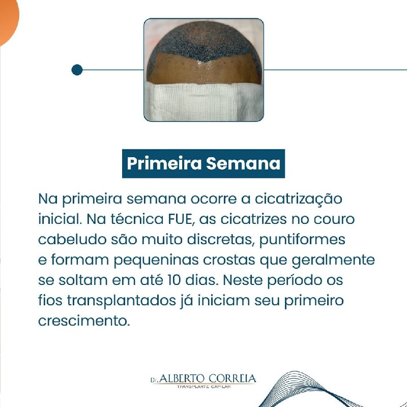 Implante de cabelo técnica fue
