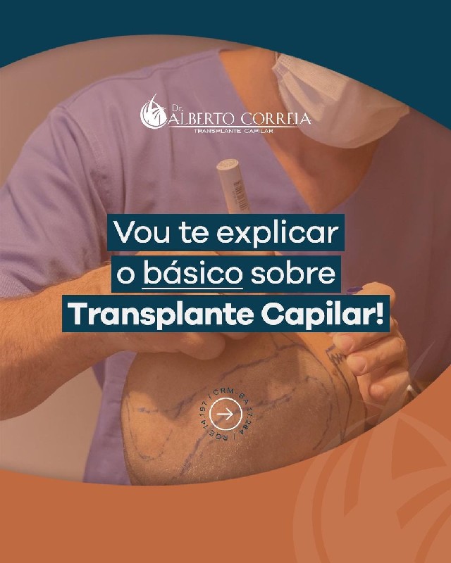 Implante capilar método fue