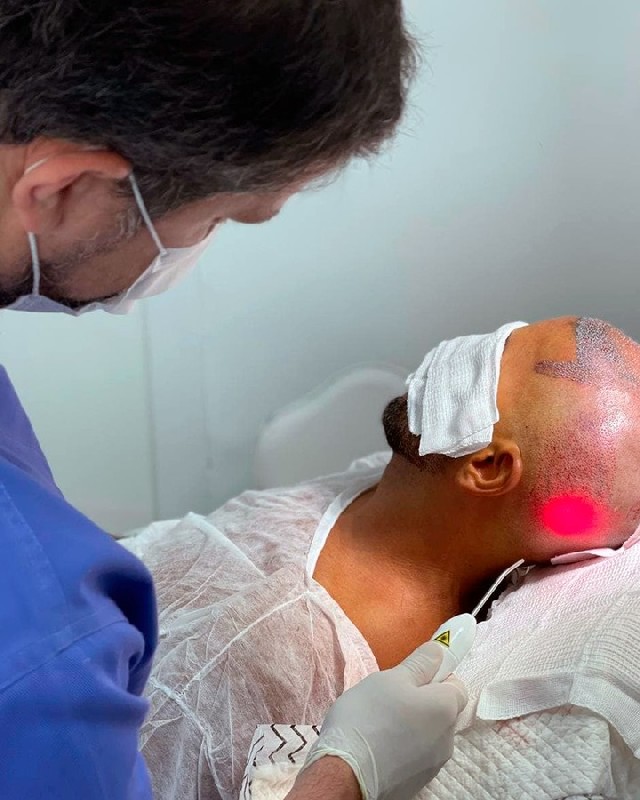 Intradermoterapia capilar com laser