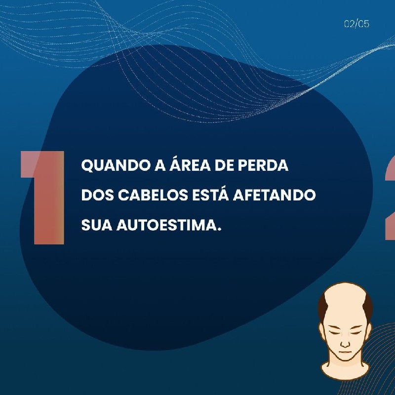 Preço implante capilar masculino