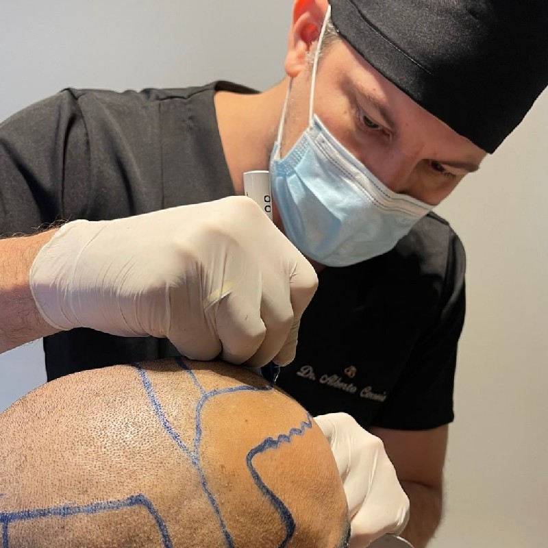 Quanto custa um transplante capilar preço