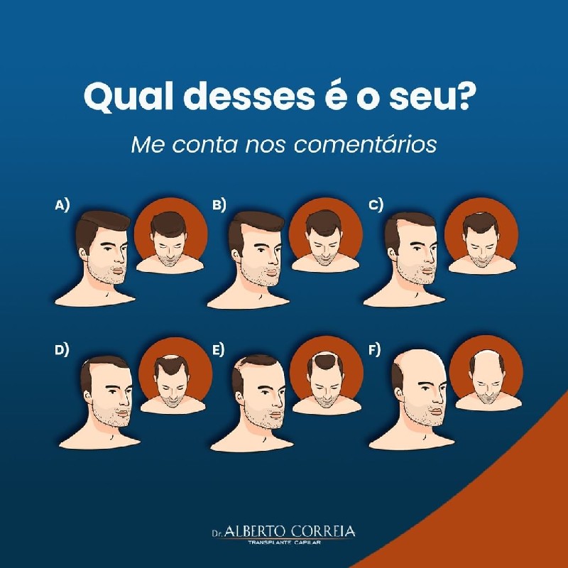 Quanto custa um tratamento para calvície