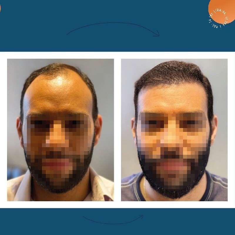 Transplante de cabelo