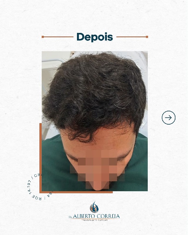 Transplante de cabelo brasil