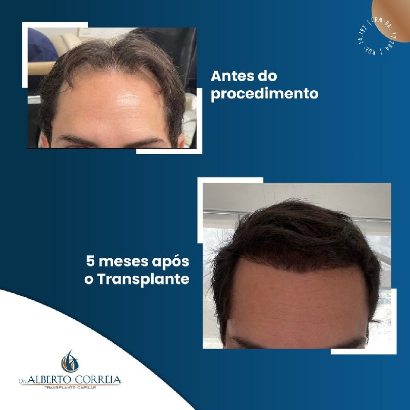 Transplante de cabelo curto