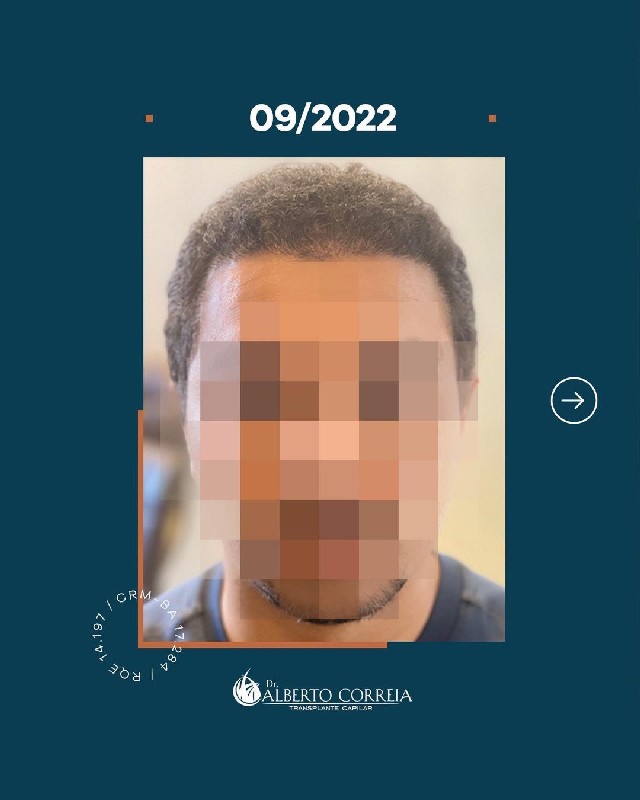 Transplante de cabelo quanto custa