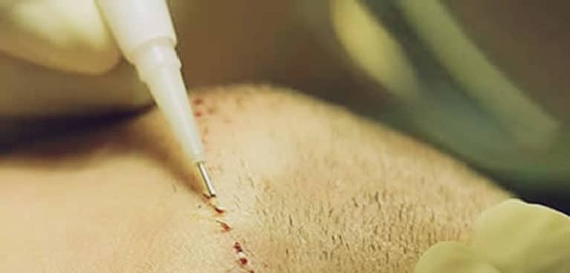 Transplante capilar fue dni