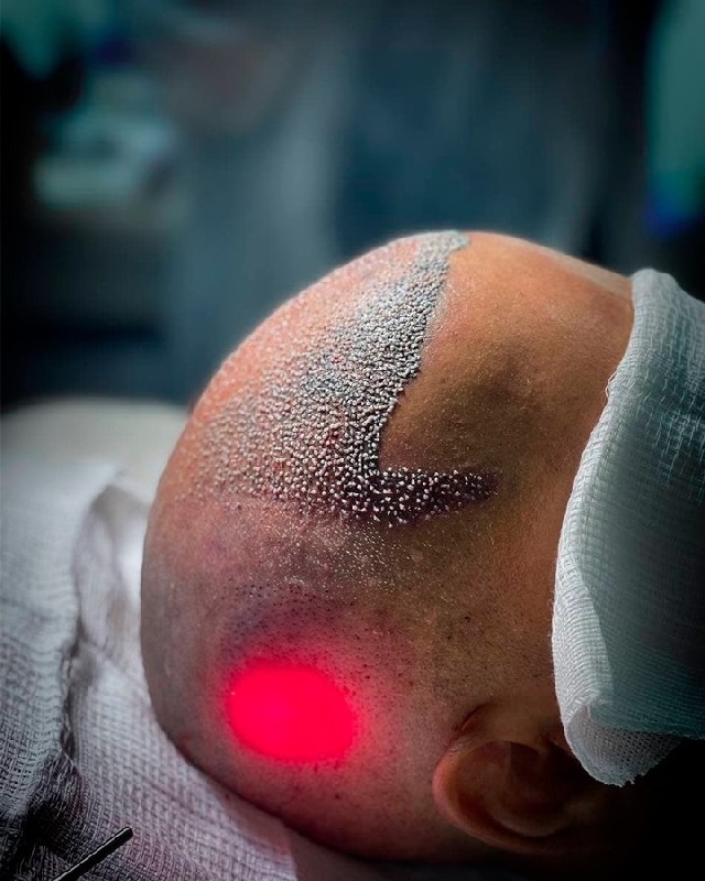 Transplante capilar a laser