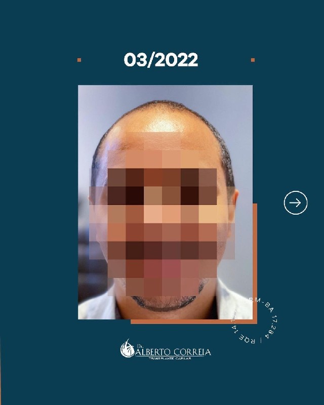 Transplante capilar masculino