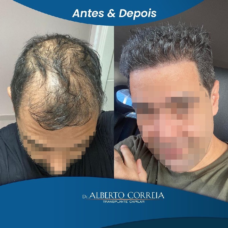 Transplante capilar técnica fue preço