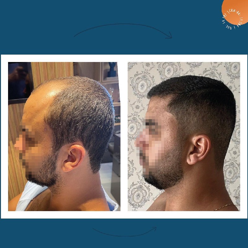 Transplante hair capilar