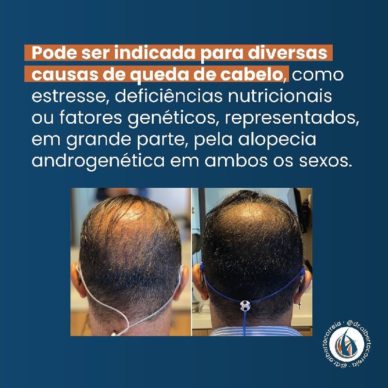 Tratamento para calvíce