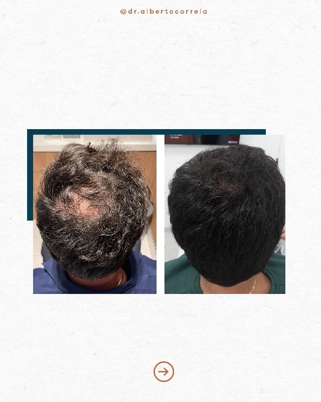 Tratamento para calvície genética