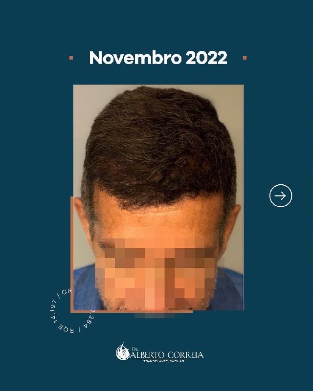 Tratamento para calvície implante