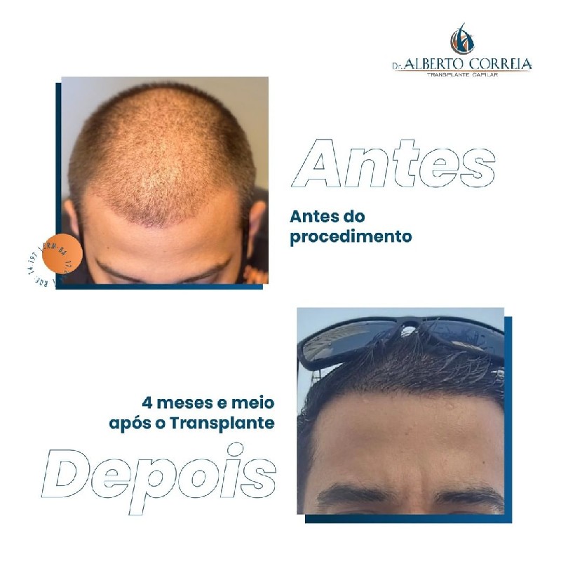 Tratamento para calvície transplante capilar