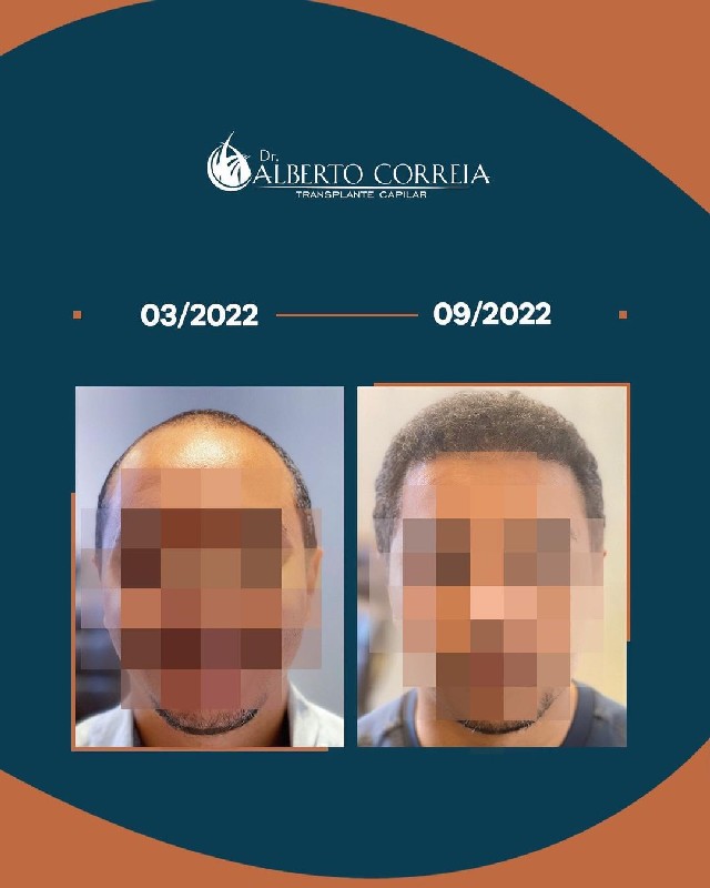 Tratamento capilar fue